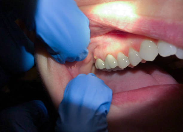 Best Knocked-Out Tooth (Avulsed Tooth) Treatment in Oak Valley, NJ